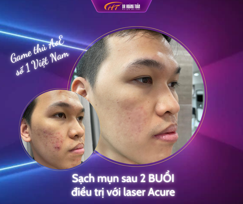 trị mụn bằng laser bao nhiêu tiền